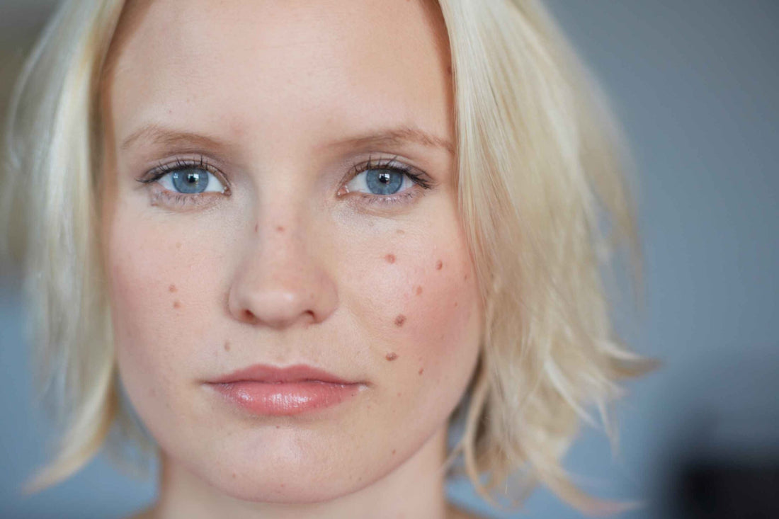 Acne vs. Pimples: What’s the Real Difference? | Haute and Chic Skincare