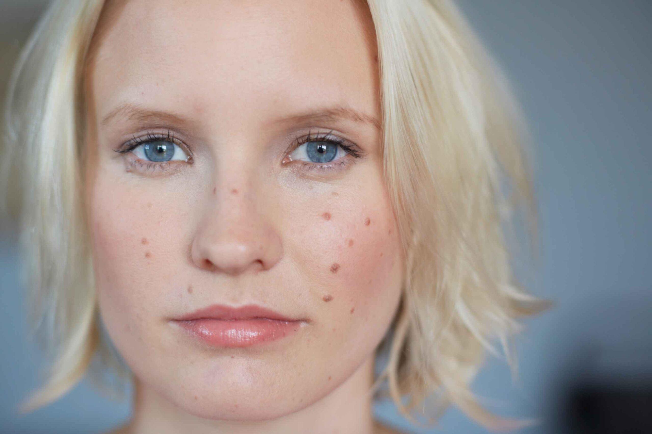 Acne vs. Pimples: What’s the Real Difference? | Haute and Chic Skincare